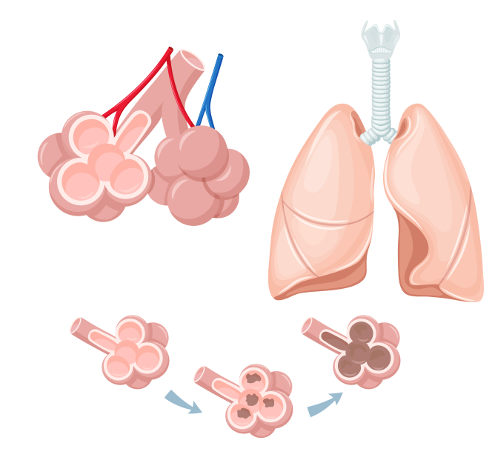 Observe como o enfisema pulmonar destrói gradativamente os alvéolos pulmonares