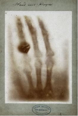 Radiografia da mão da esposa de Röntgen, Anna Bertha Ludwig