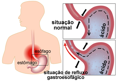 Esquema de como ocorre o refluxo gastroesofágico