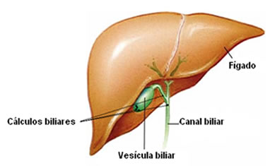 O cálculo biliar pode ficar na própria vesícula, ir para o canal biliar ou ser empurrado para o intestino.